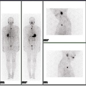 Iodine-123 whole body scan for thyroid cancer evaluation.