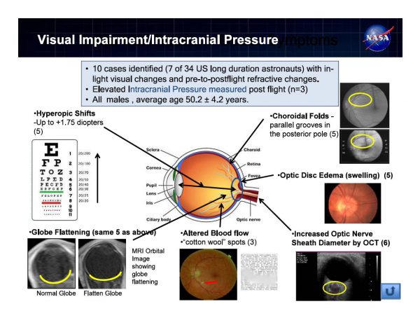 Visual Impairment/Intracranial Pressure